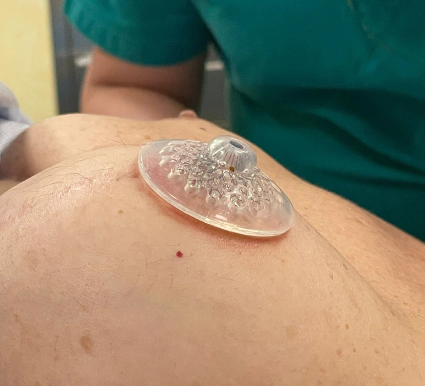 nipple-implant
